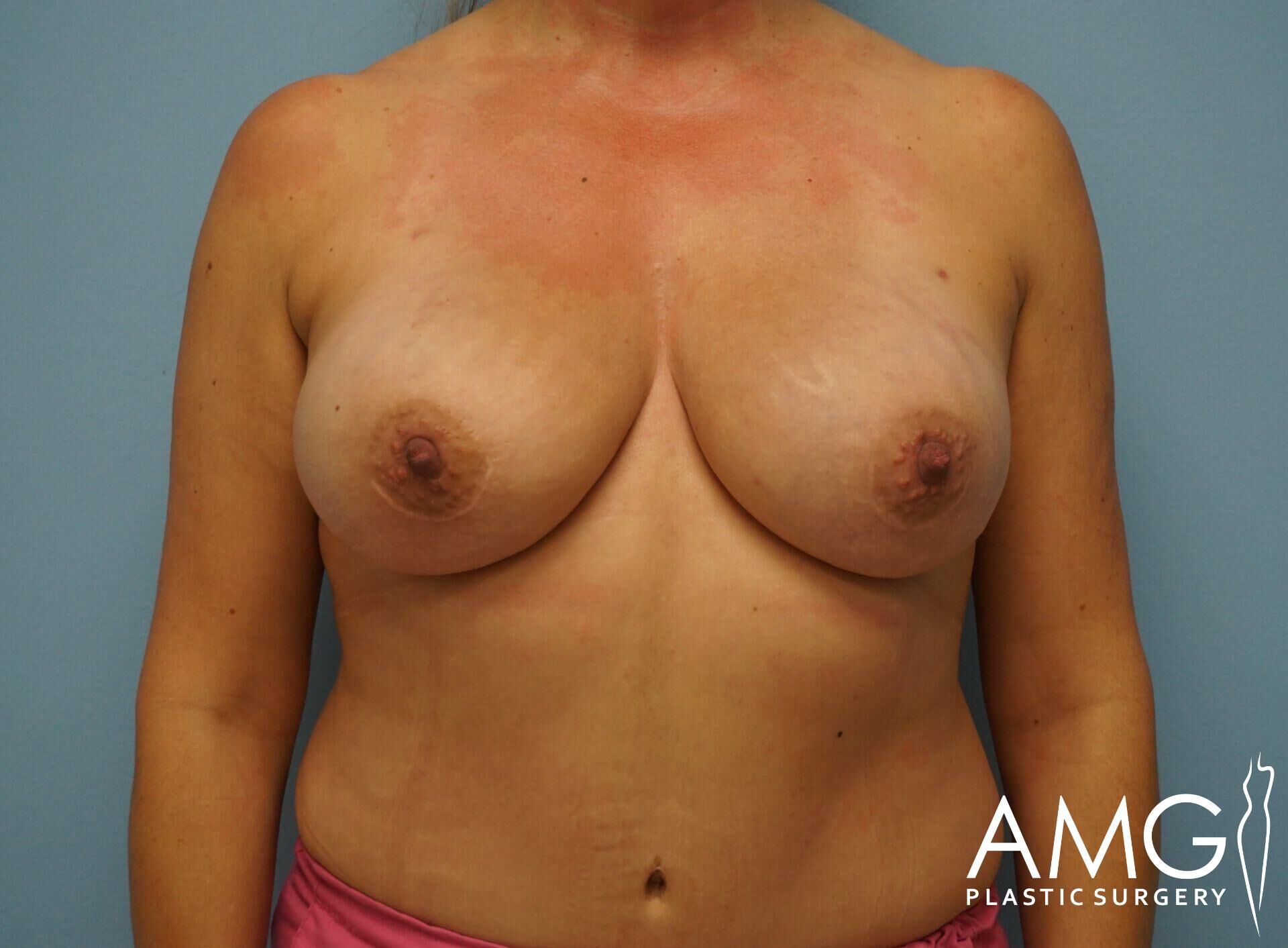 A person standing against a blue background, with visible signs of sunburn on the upper chest and shoulders.