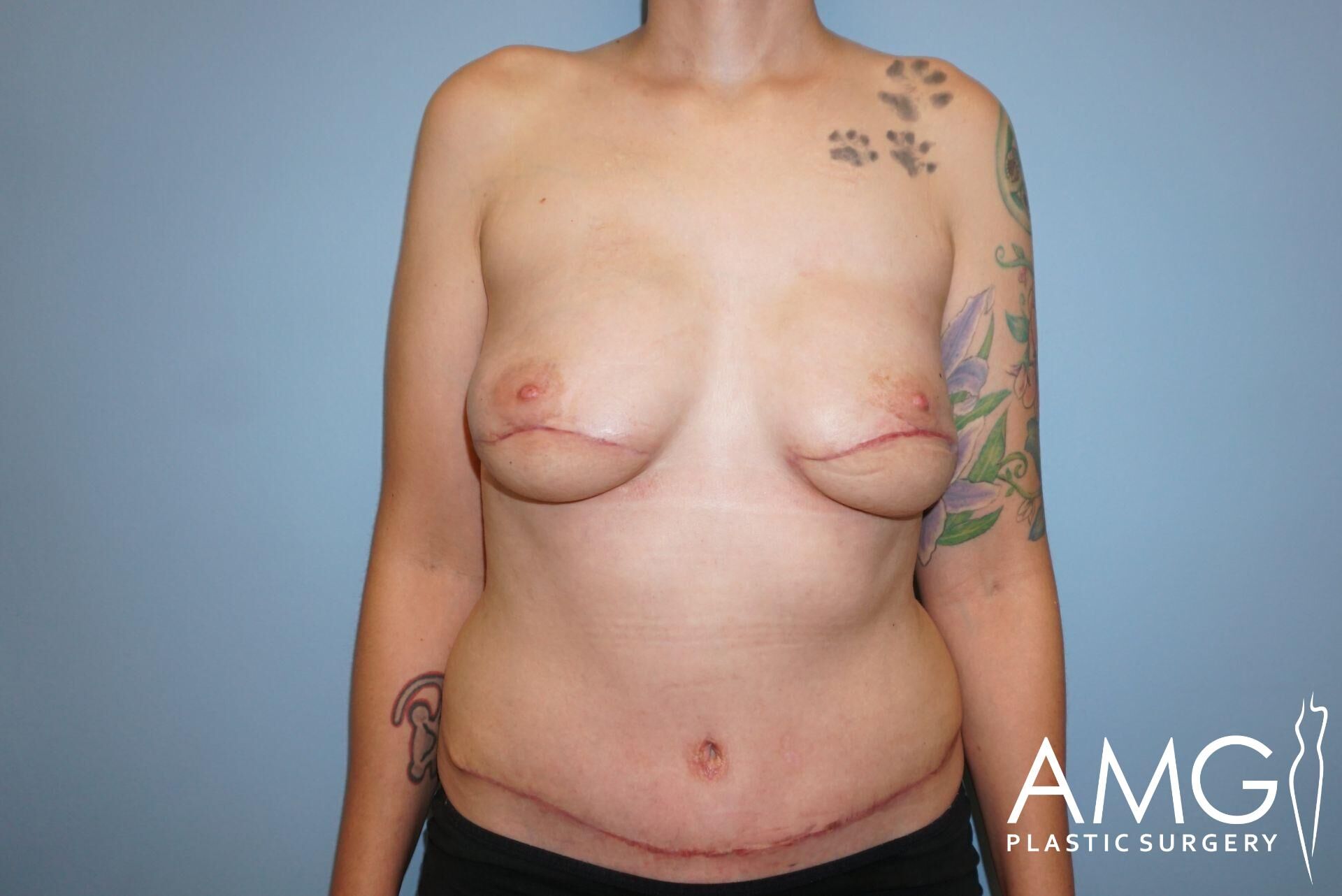 Person with visible surgical scars on chest and abdomen, standing against a blue background. Tattoos are visible on both arms. Logo in the bottom right corner reads "AMG Plastic Surgery.