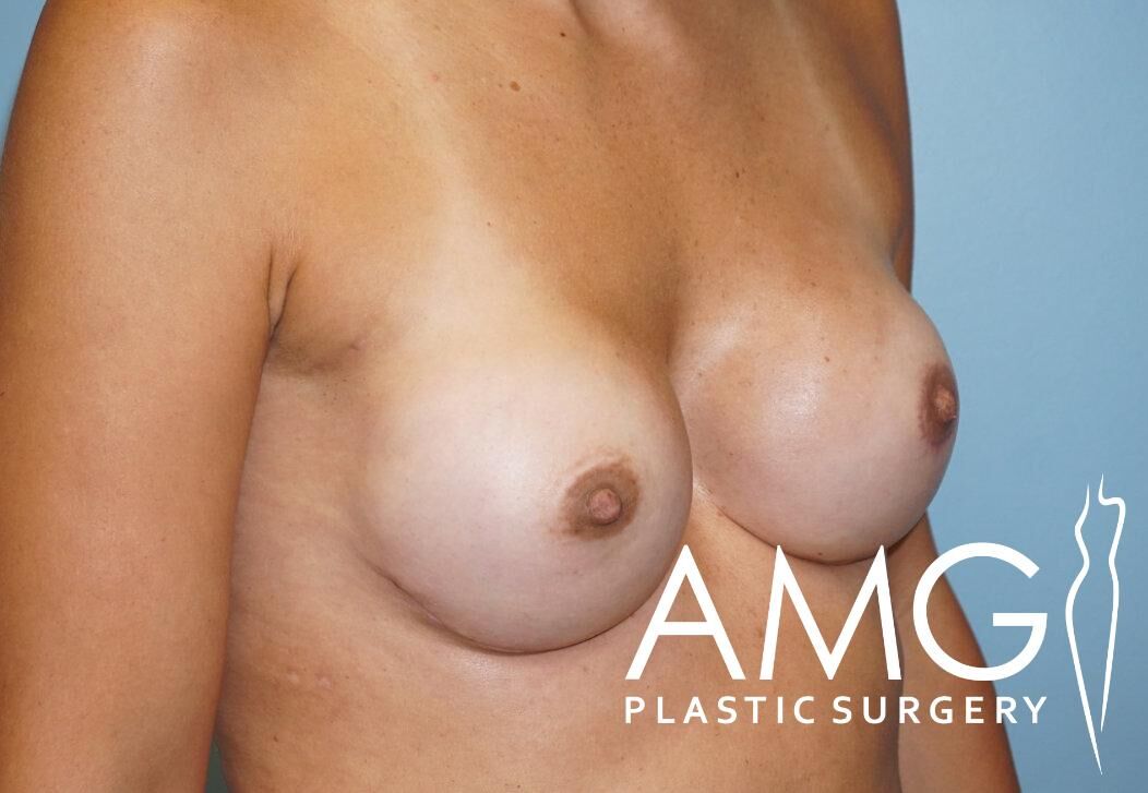 Close-up of a person’s bare torso showing breast augmentation. The AMG Plastic Surgery logo appears in the bottom right corner.