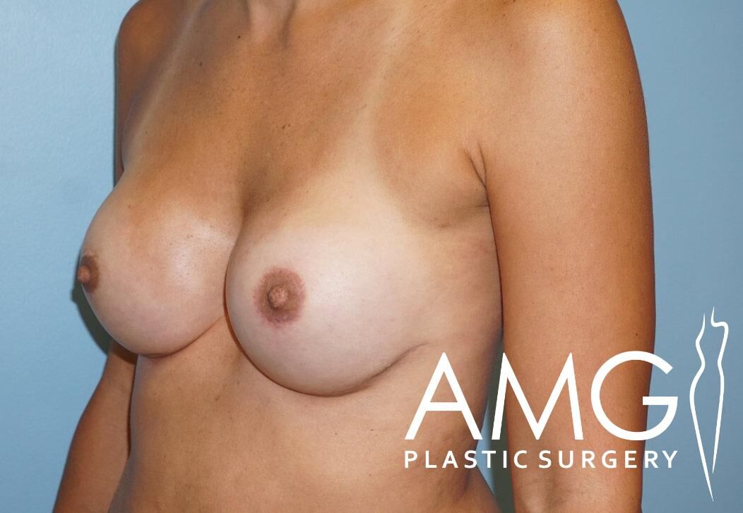A woman’s torso viewed from the side against a blue background, with a logo for AMG Plastic Surgery in the lower right corner.