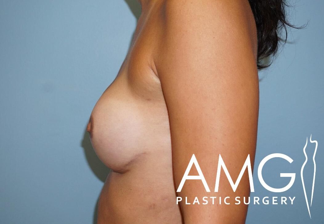 Profile view of a woman's torso, focusing on the breast area, with a logo in the corner reading "AMG Plastic Surgery.