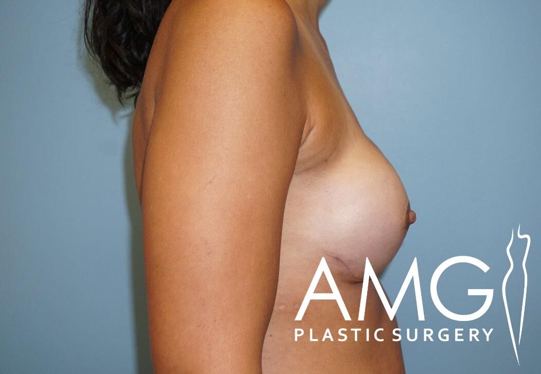 Side view of a person's upper body against a light blue background, with a logo for AMG Plastic Surgery in the lower right corner.