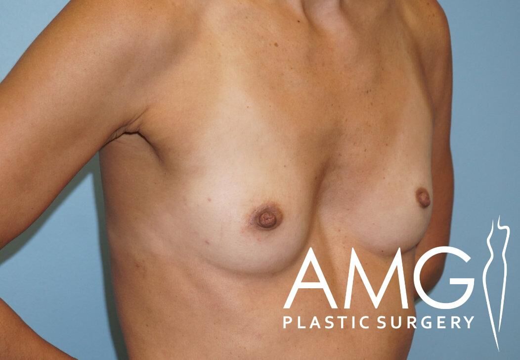 Person's upper torso with a surgical scar visible on the chest. Logo "AMG Plastic Surgery" in the corner.