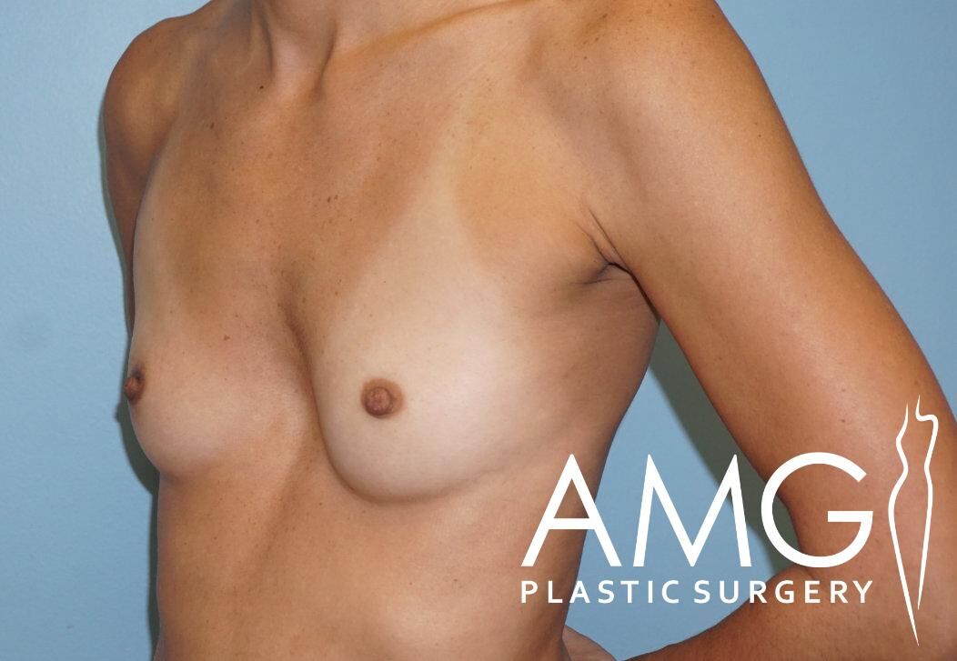 Person with a bare torso standing against a blue background, showing the left side. "AMG Plastic Surgery" text and logo in the lower right corner.