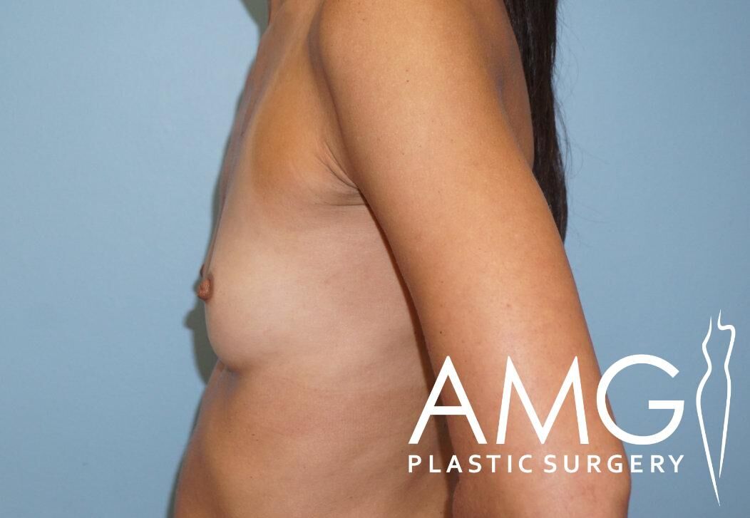 Side view of a person's bare upper torso against a blue background, featuring the logo "AMG Plastic Surgery" in the bottom right corner.