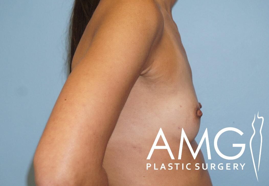Person's bare upper body in profile against a blue background, displaying a flat chest. AMG Plastic Surgery logo is visible in the bottom right corner.