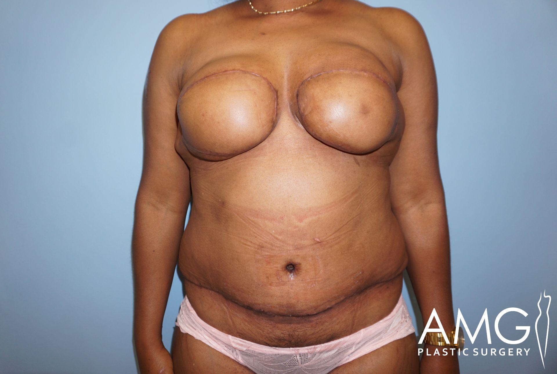 Person showing post-surgery scars on the abdomen and around the breasts, wearing underwear, against a blue background. Logo in the bottom right says AMG Plastic Surgery.