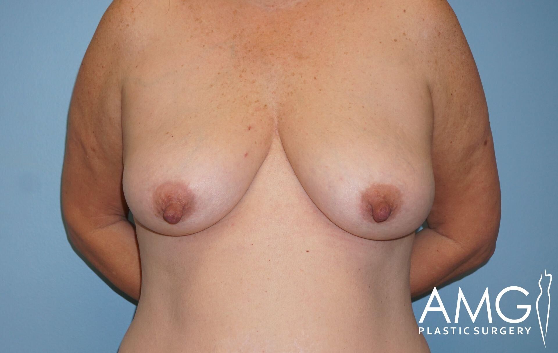 A person is shown from the neck to the waist, standing against a blue background with arms behind their back. The image features a watermark for AMG Plastic Surgery.