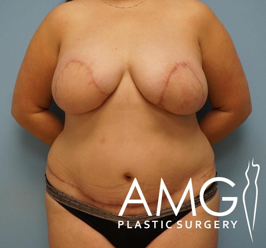 A person with surgical scars on their chest and abdomen stands against a blue background, wearing black underwear. AMG Plastic Surgery logo is visible in the bottom right corner.
