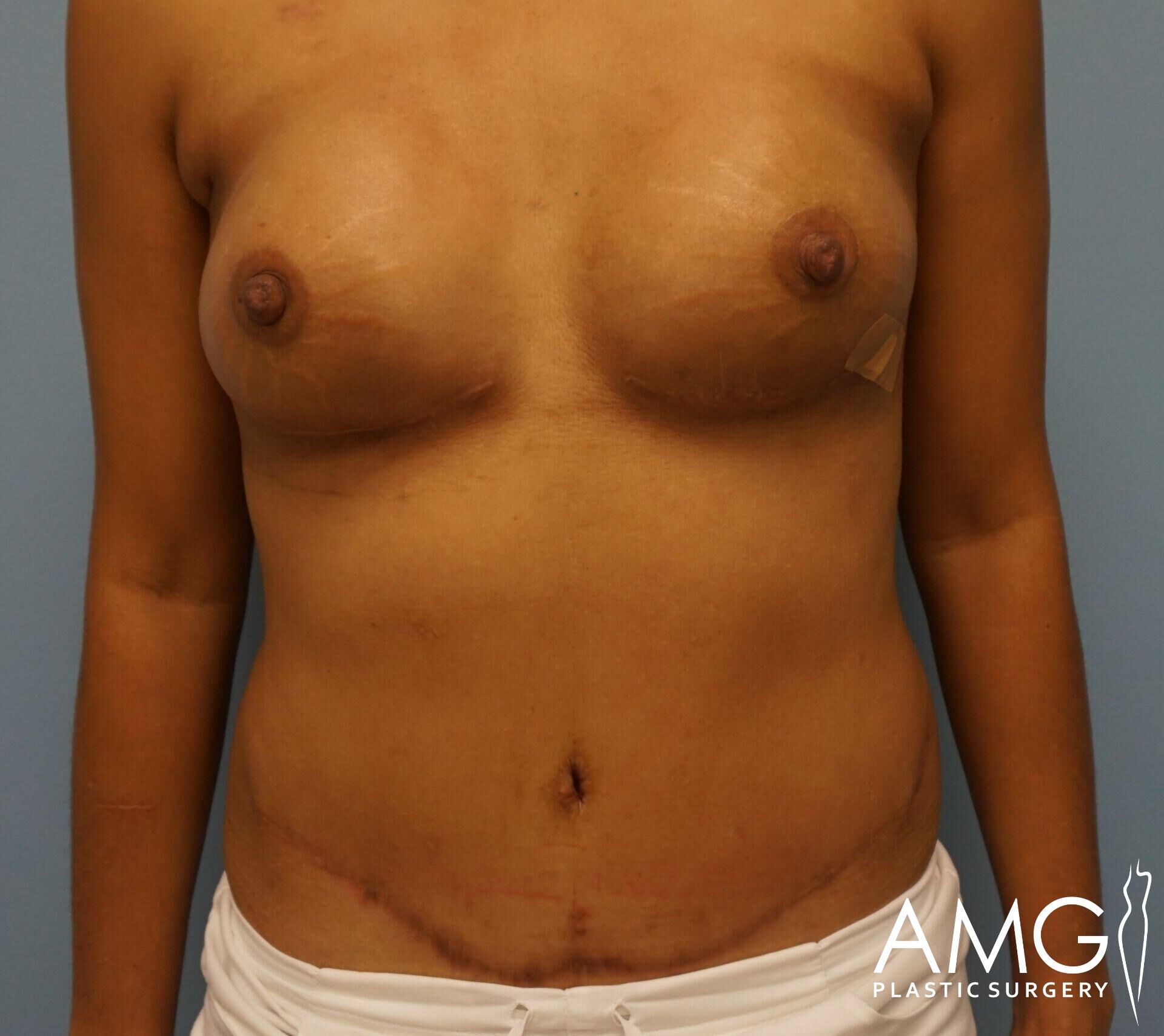 A person with healing scars on their abdomen and adhesive tape on their chest, possibly after surgery, stands against a plain blue background.