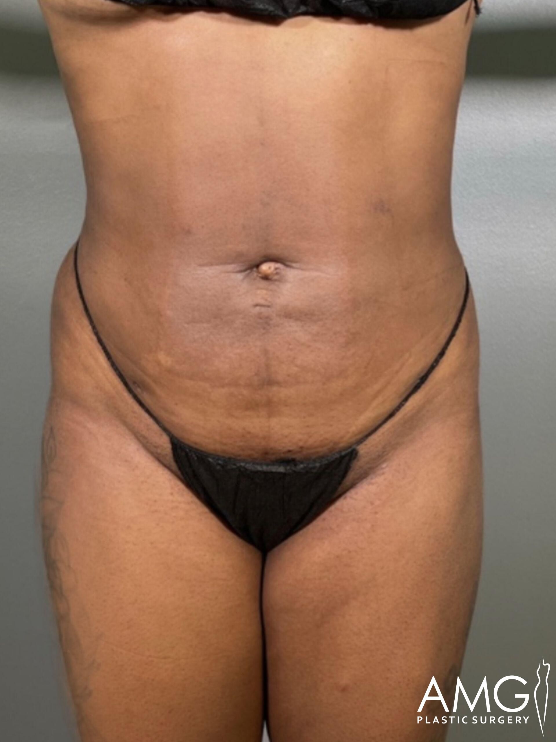 Person in black underwear stands against a gray background, showing their torso and upper legs. "AMG Plastic Surgery" is visible in the bottom corner.