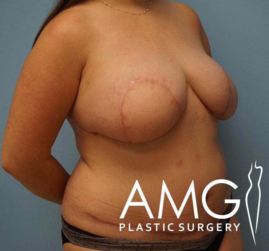 A person standing, showing surgical scars on the chest. Logo text reads "AMG Plastic Surgery.