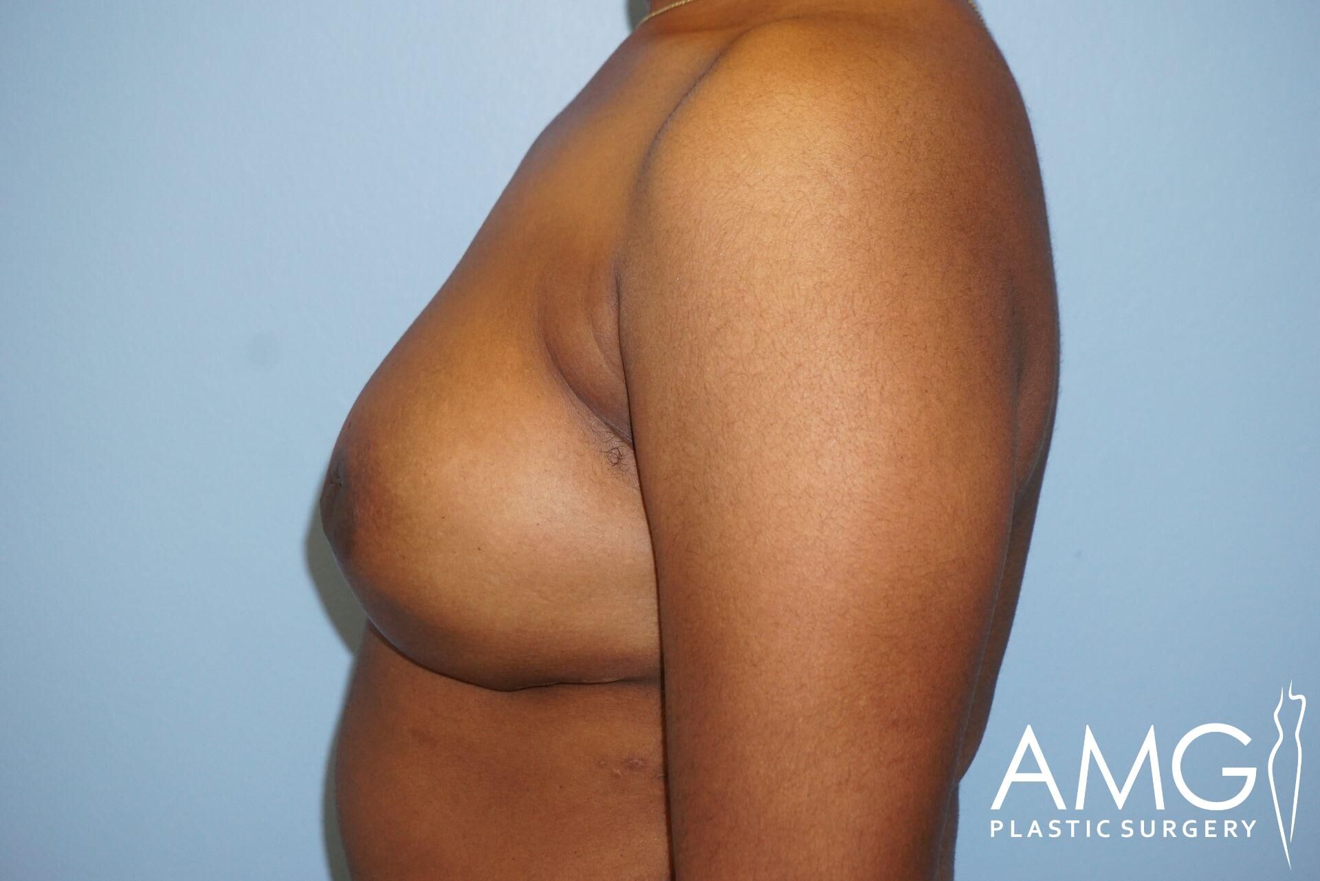 Side view of a person’s bare upper torso with visible breast tissue, against a light blue background. The image has AMG Plastic Surgery branding.