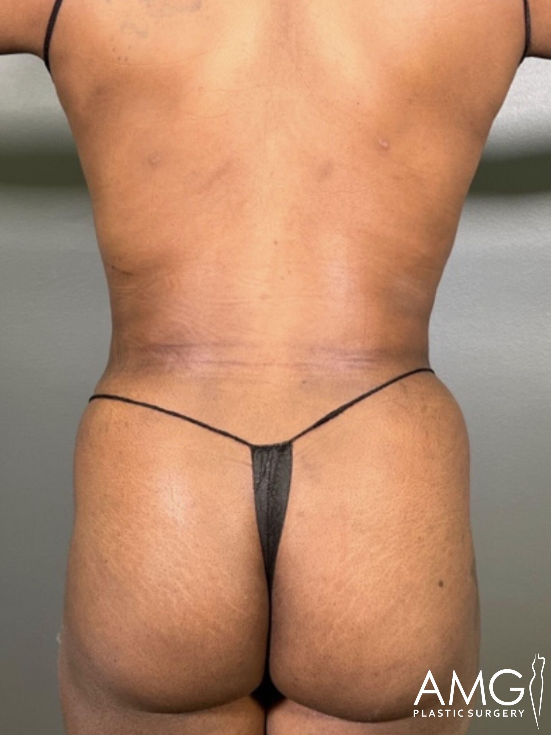 Rear view of a person wearing minimal black underwear, showcasing a bare back and buttocks. Logo at the bottom right reads "AMG Plastic Surgery.