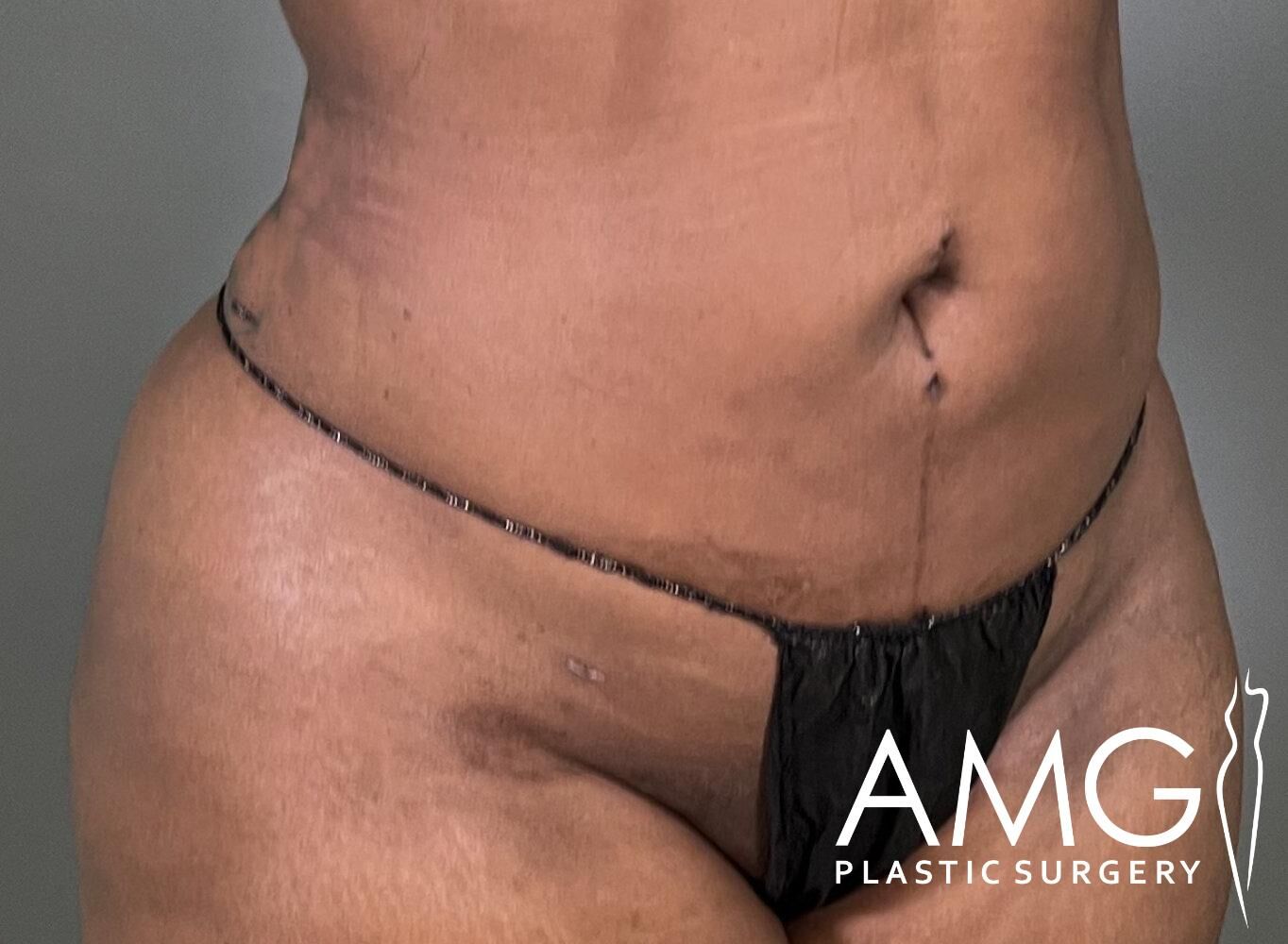 Close-up of a person's abdomen and waist wearing a black garment, with a visible surgical incision. Logo reads "AMG Plastic Surgery.
