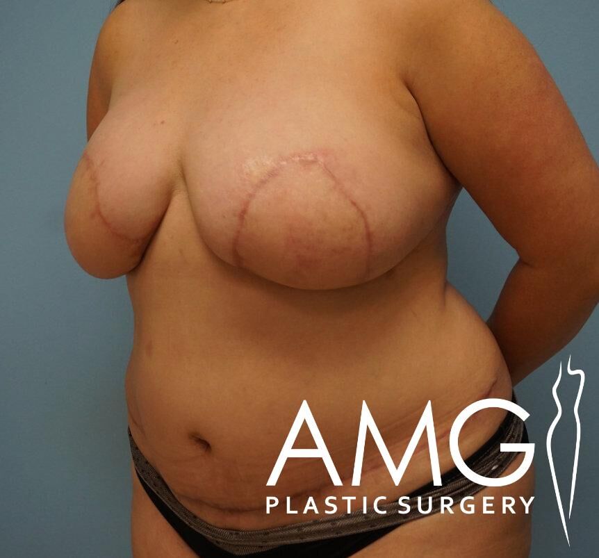 A person with visible surgical scars on their breasts stands against a blue background.