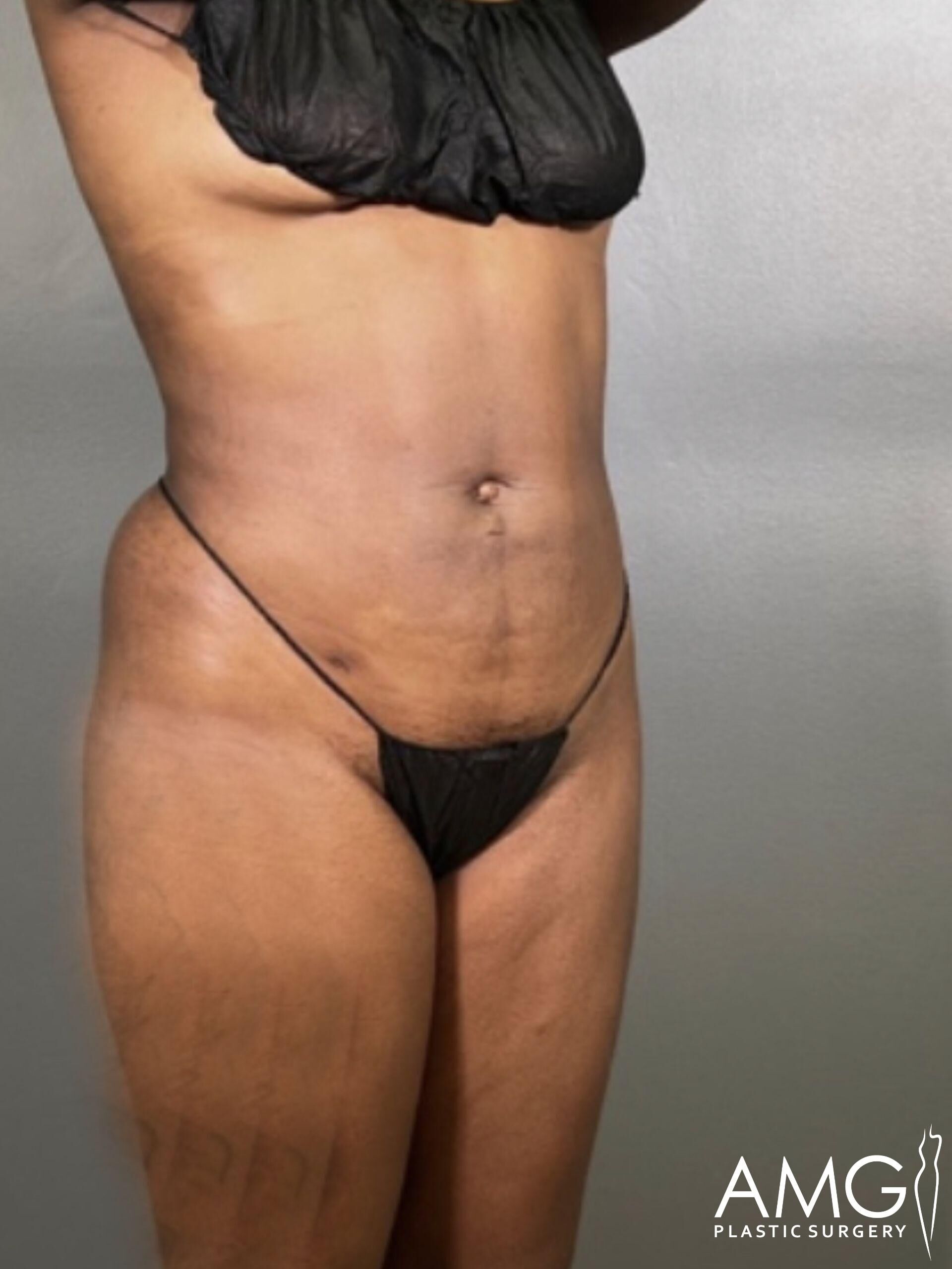 A person standing, wearing minimal black clothing, showing a focused view of their midsection and thighs. "AMG Plastic Surgery" logo is visible in the corner.