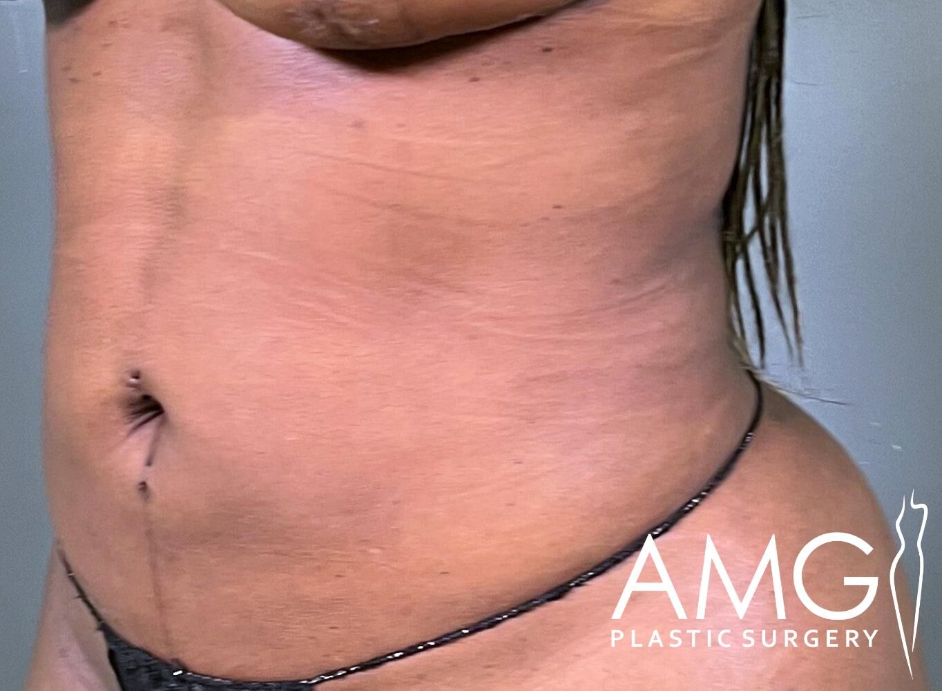 A person's midsection showing a flat stomach and a thin waistband. The image features the logo "AMG Plastic Surgery" in the corner.