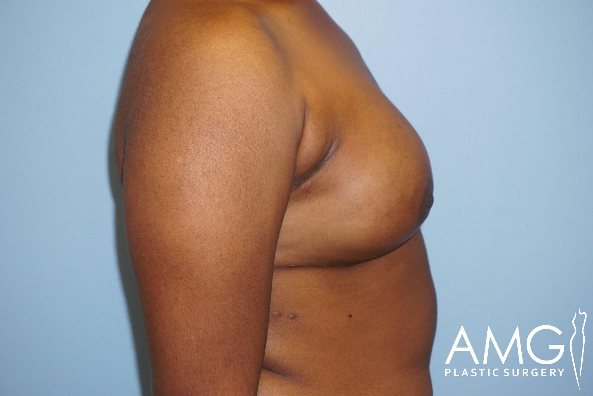 Side view of a person's bare upper torso and arm against a blue background.