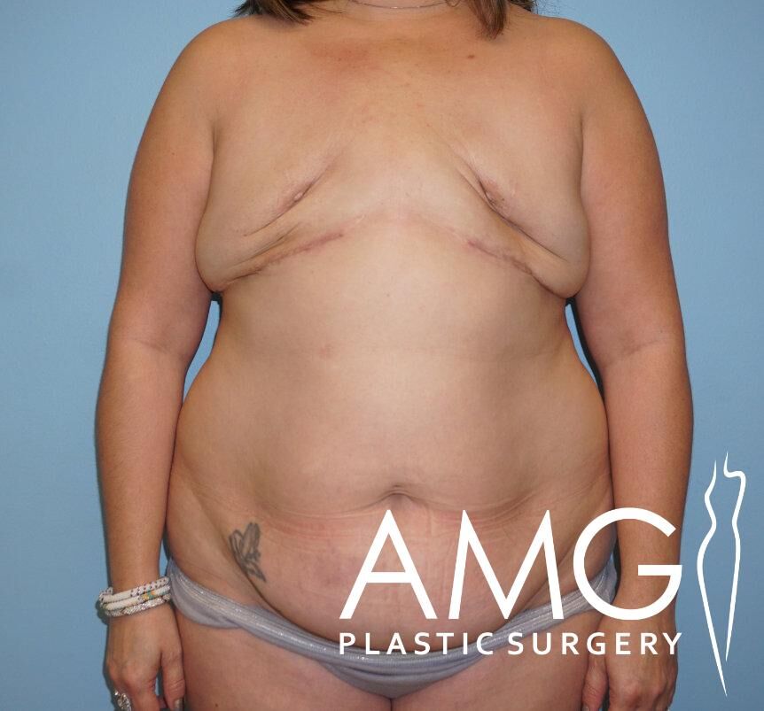 A person with post-surgery marks on their chest standing against a blue background. 