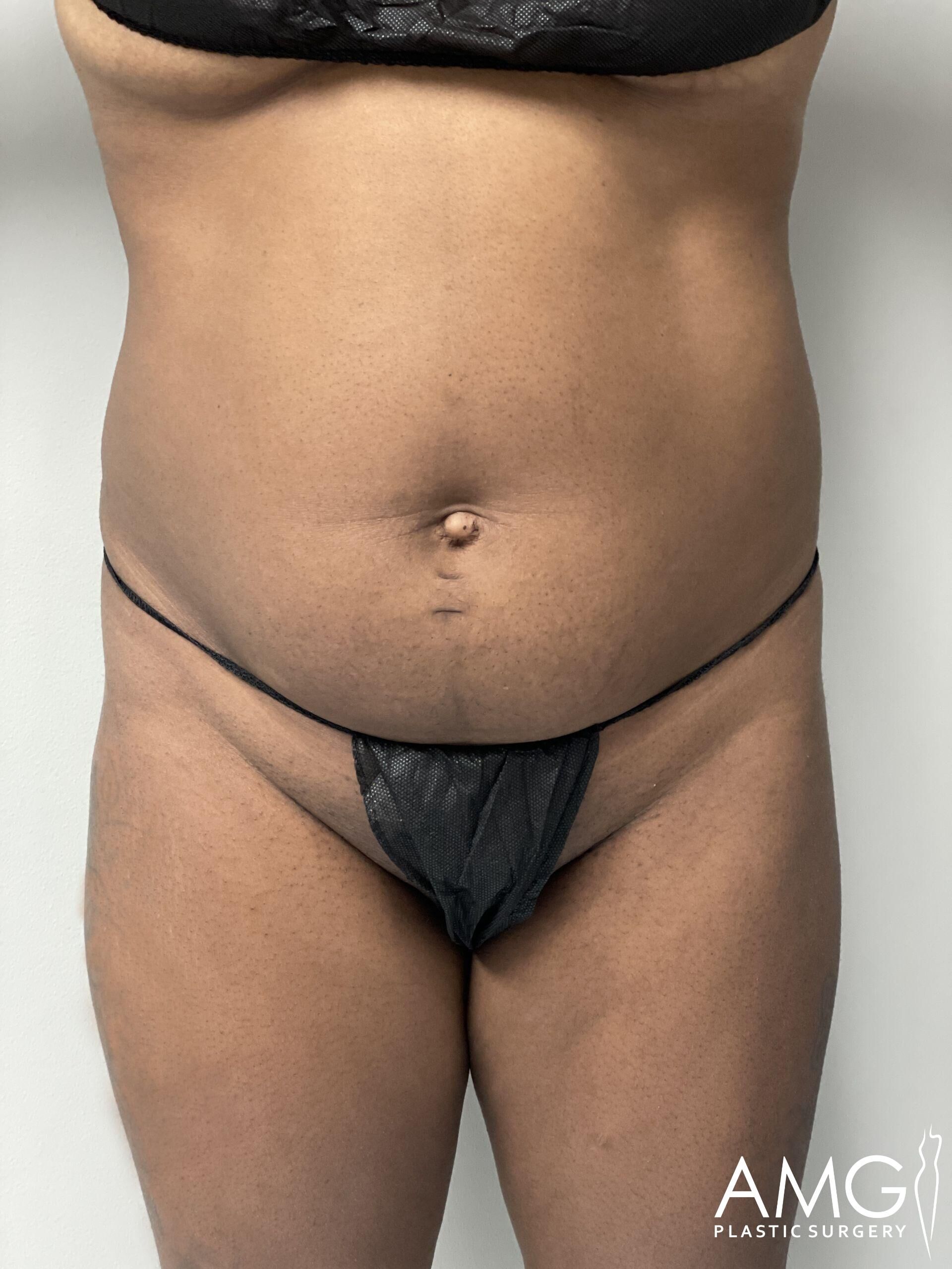 A person is standing, wearing a black top and dark underwear. The image focuses on the abdomen area, showing the torso and upper legs. A logo for AMG Plastic Surgery is visible in the bottom right corner.