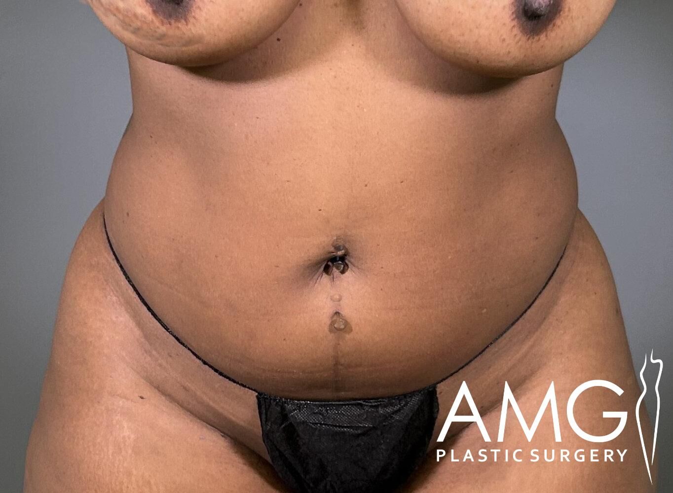 Close-up of a person's midsection with a focus on the abdominal area, displaying a faint surgical mark. The image has a logo in the bottom right corner that reads "AMG Plastic Surgery.