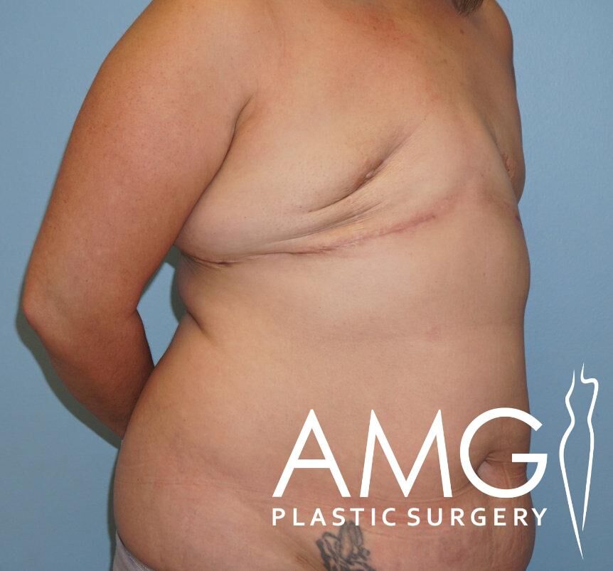 Side view of a person with a visible back scar, minimal clothing, and a tattoo on the lower back. Blue background with a logo for AMG Plastic Surgery.