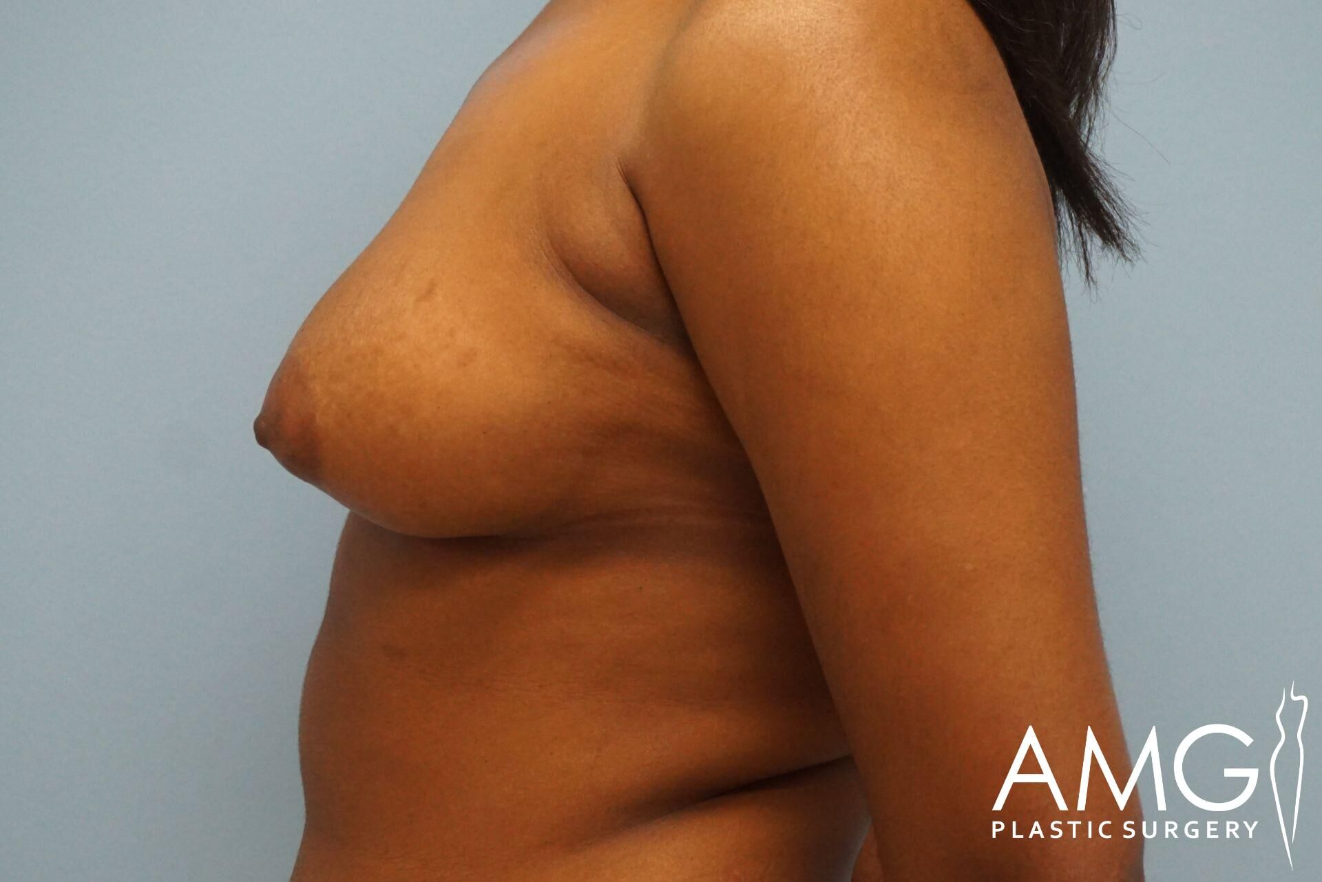 Side profile of a person's bare upper torso, showing the right side against a blue background. AMG Plastic Surgery logo in the bottom right corner.