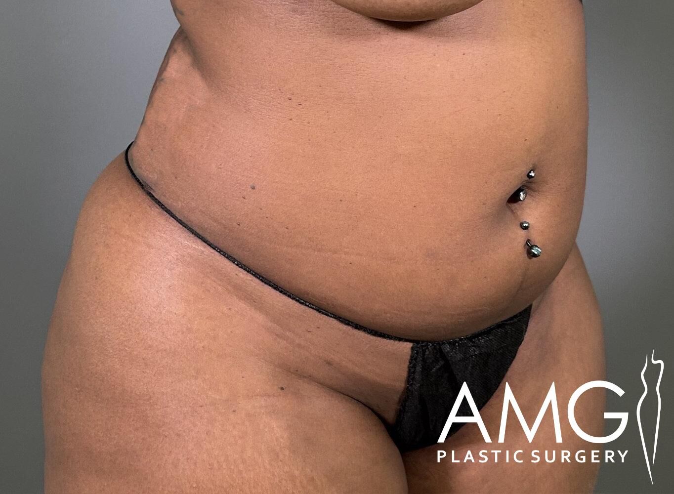 A close-up of a person’s torso with a navel piercing, wearing a black garment. The image features a logo for AMG Plastic Surgery.