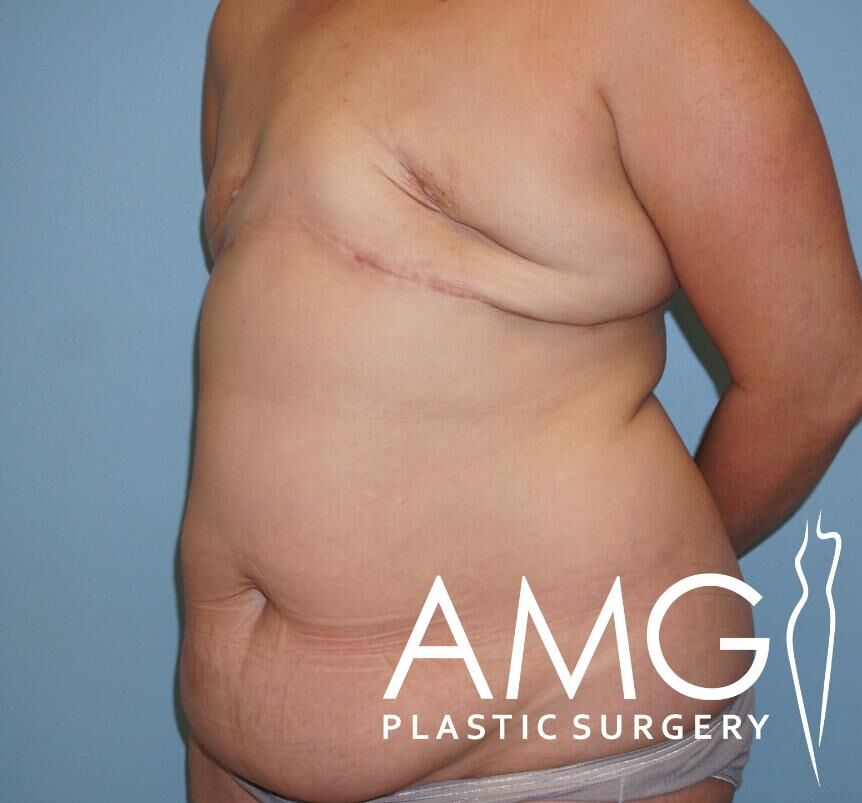 Side view of a person's torso showing post-surgical scars and sagging skin. The image displays the logo "AMG Plastic Surgery" in the corner.