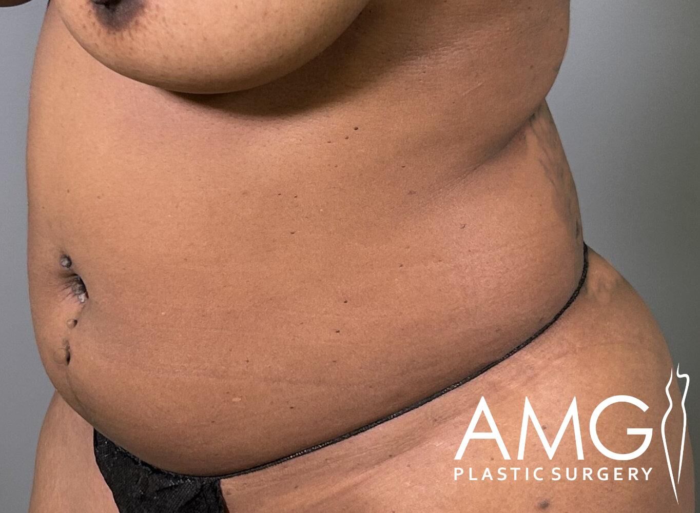 Close-up of a person's torso from the side, showing the abdomen and waist area. There is a small logo in the bottom right corner reading "AMG Plastic Surgery.