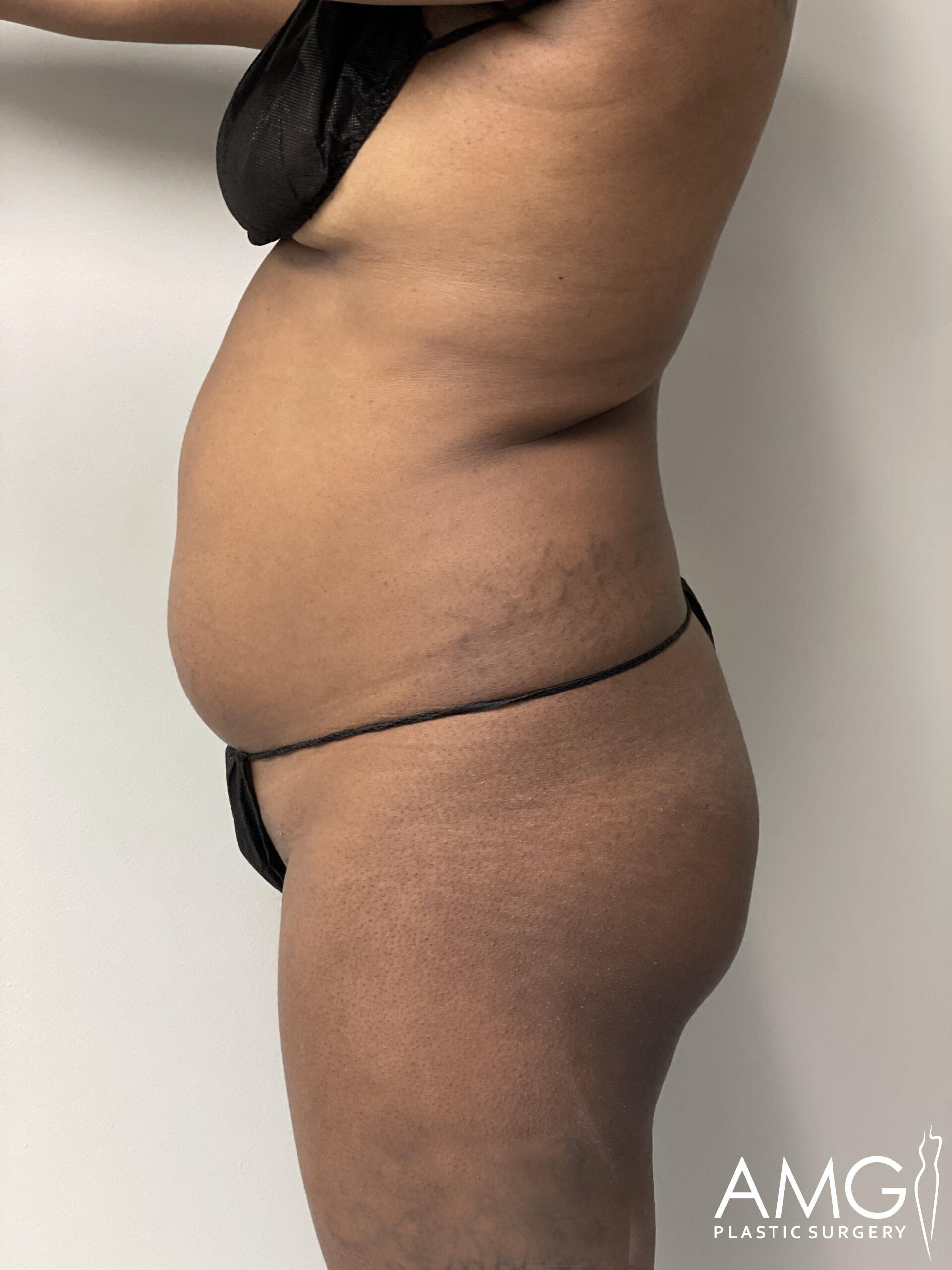 Side profile of a person standing against a plain background, wearing black undergarments. The image includes a watermark for AMG Plastic Surgery.