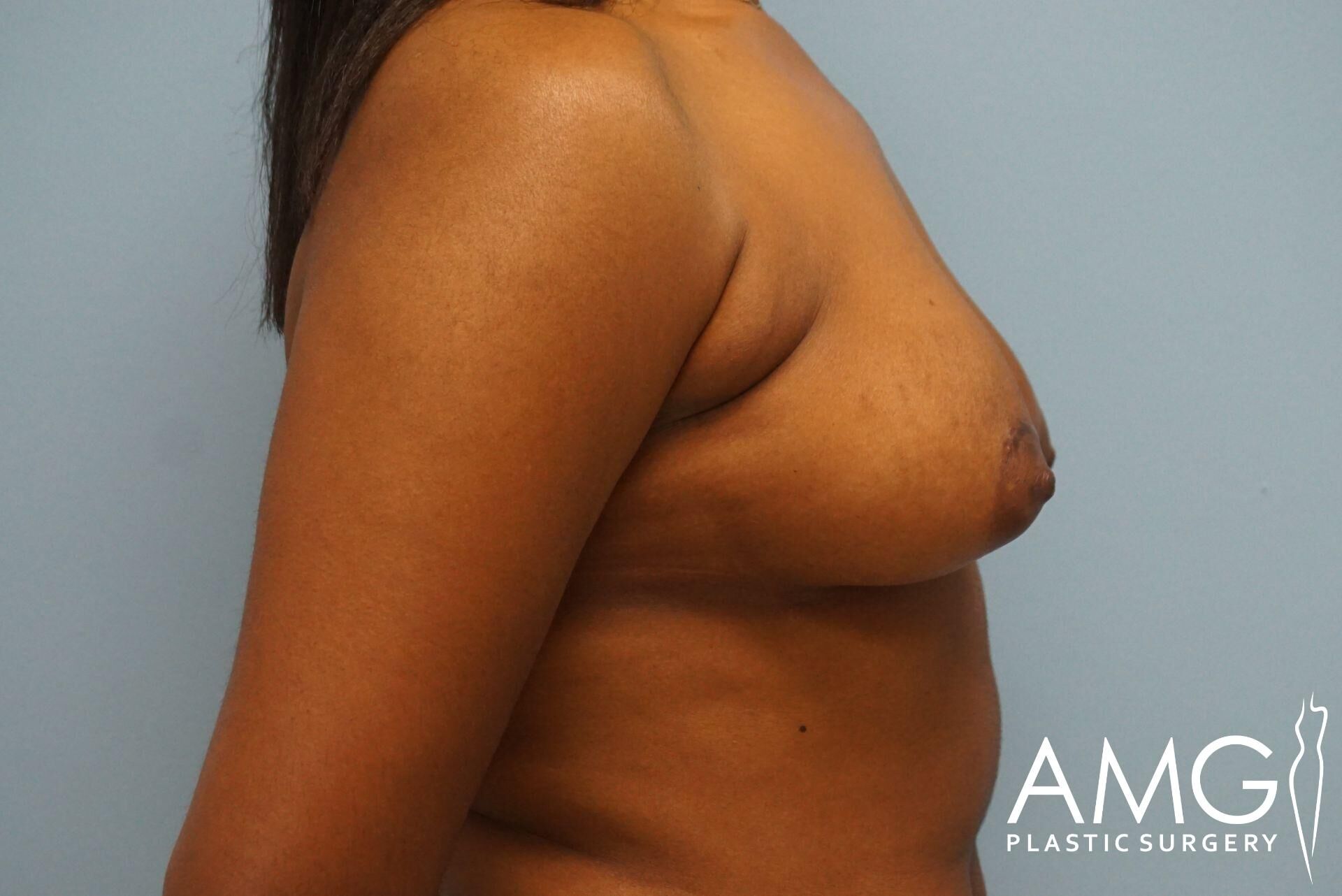 Side view of a person’s bare upper torso against a blue background. The logo "AMG Plastic Surgery" is visible in the bottom right corner.