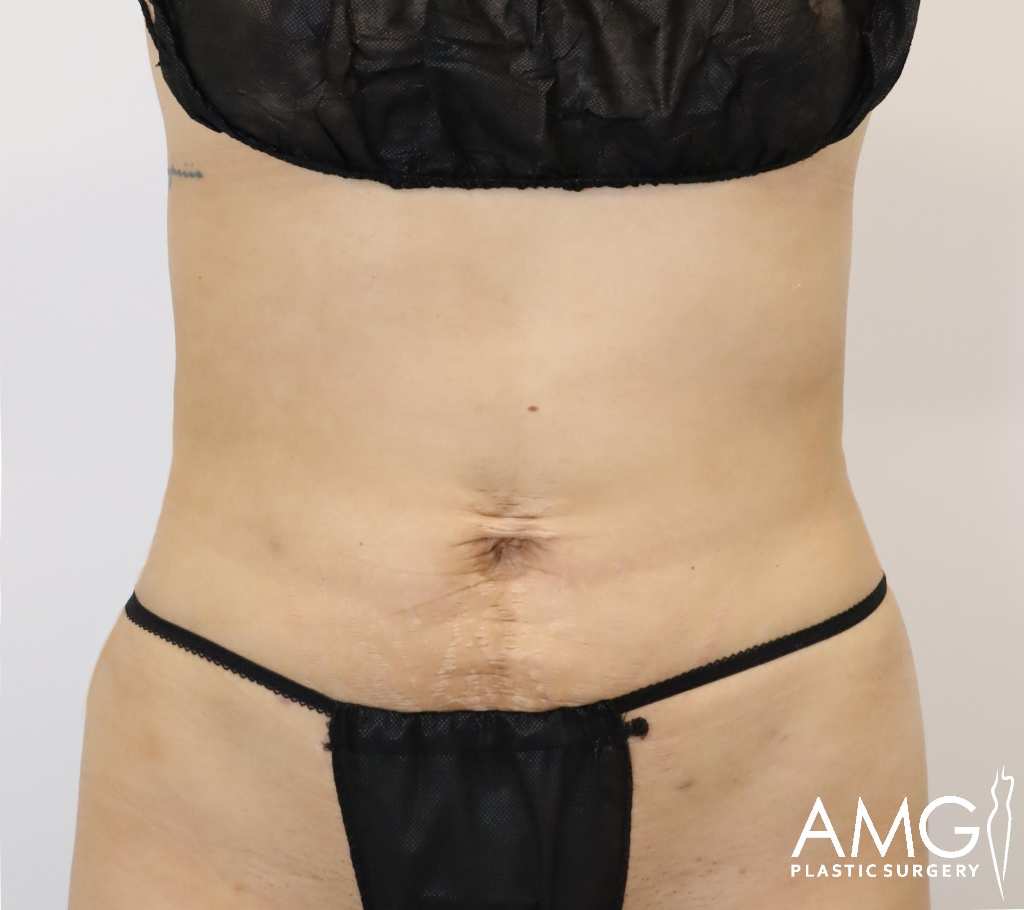Person's torso with visible skin folds and slight scarring on the abdomen, wearing a black two-piece garment. Visible branding in the corner reads 