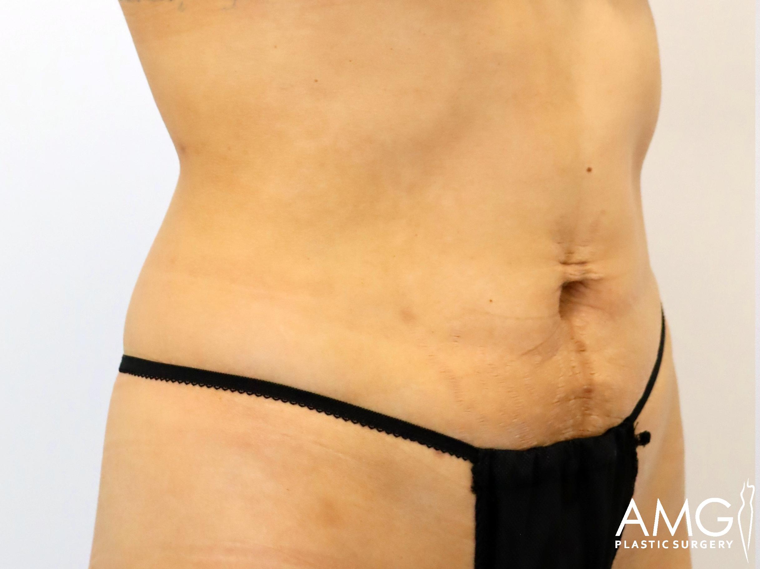 Close-up of a person's midsection showing scars and slight skin folds. They are wearing black undergarments. The image is watermarked with AMG Plastic Surgery.