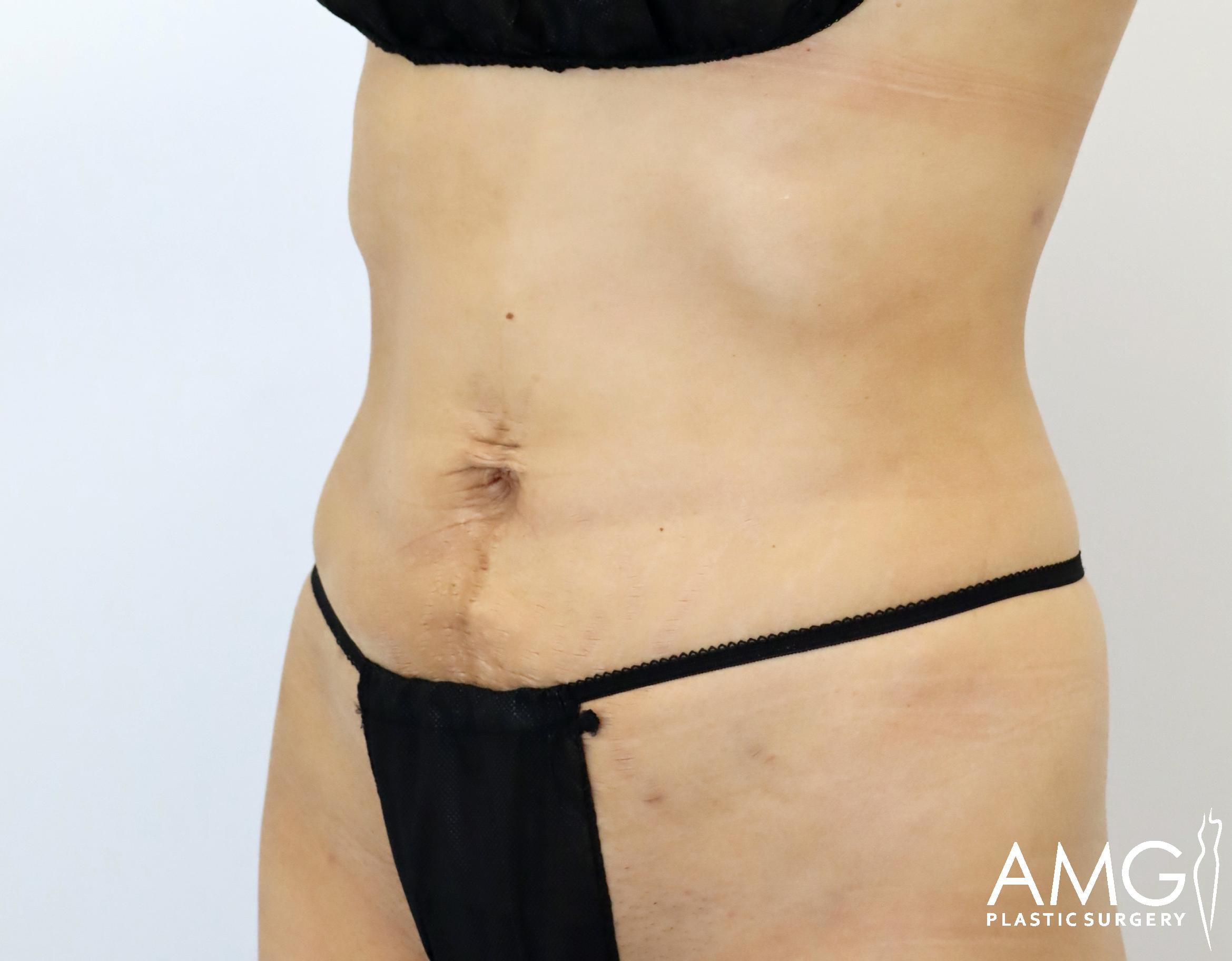 Person in black underwear showing abdomen and torso with surgery scars, against a plain background.