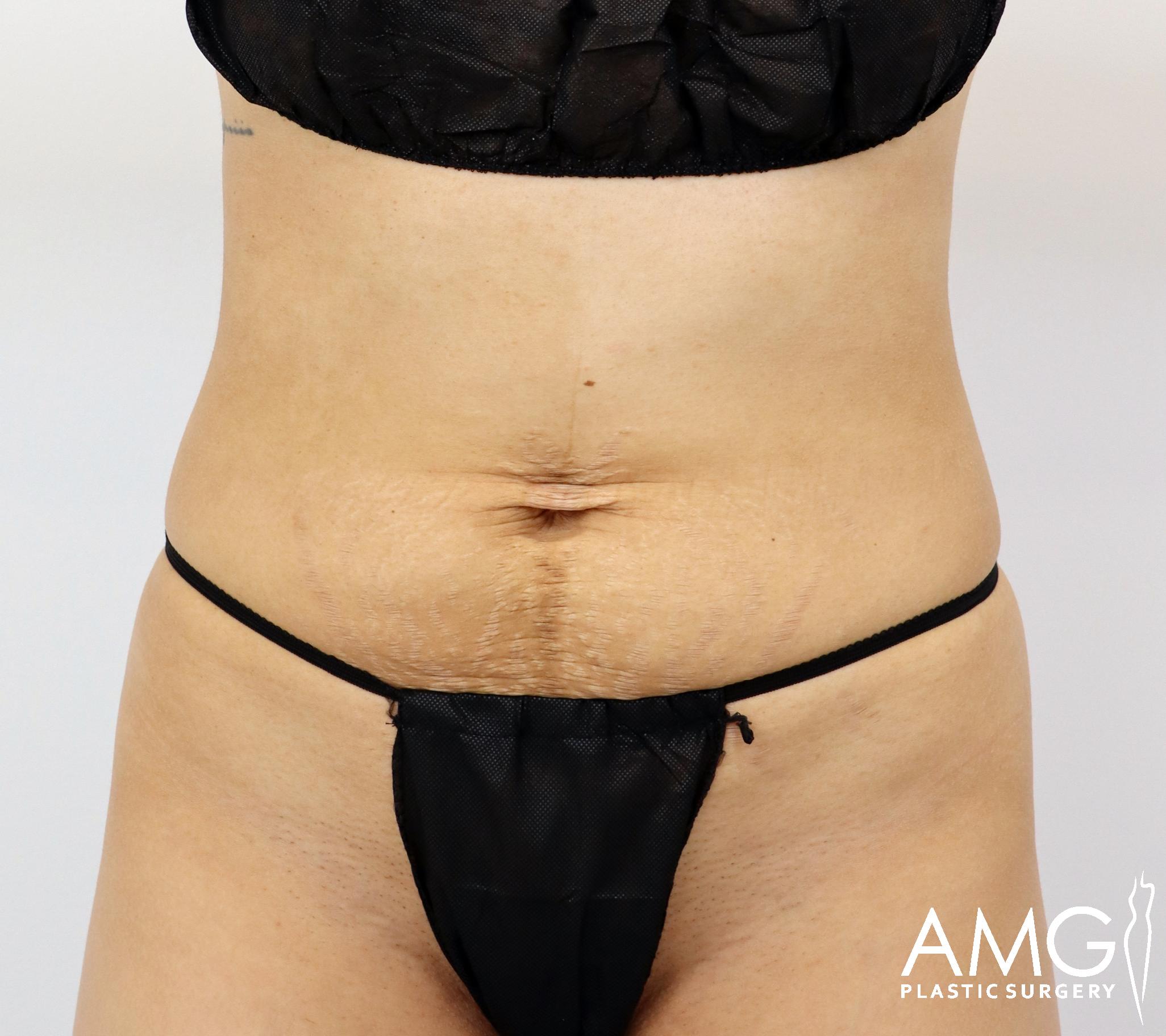 A person wearing black undergarments showing the midsection with visible stretch marks and slightly sagging skin. Logo in the lower right corner.