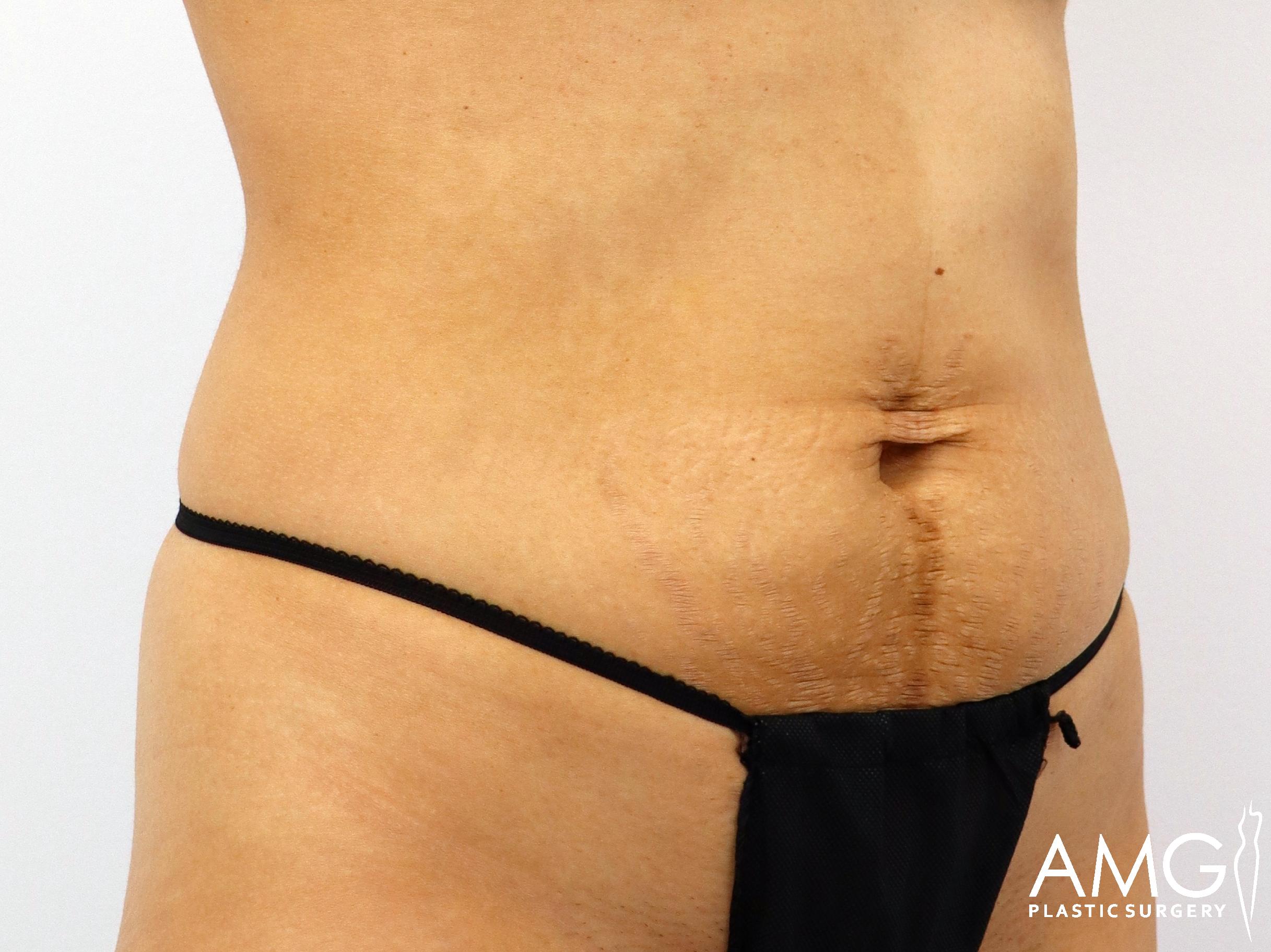 Close-up of a person's abdomen with stretch marks and loose skin, wearing black underwear. Plastic surgery logo in bottom right corner.