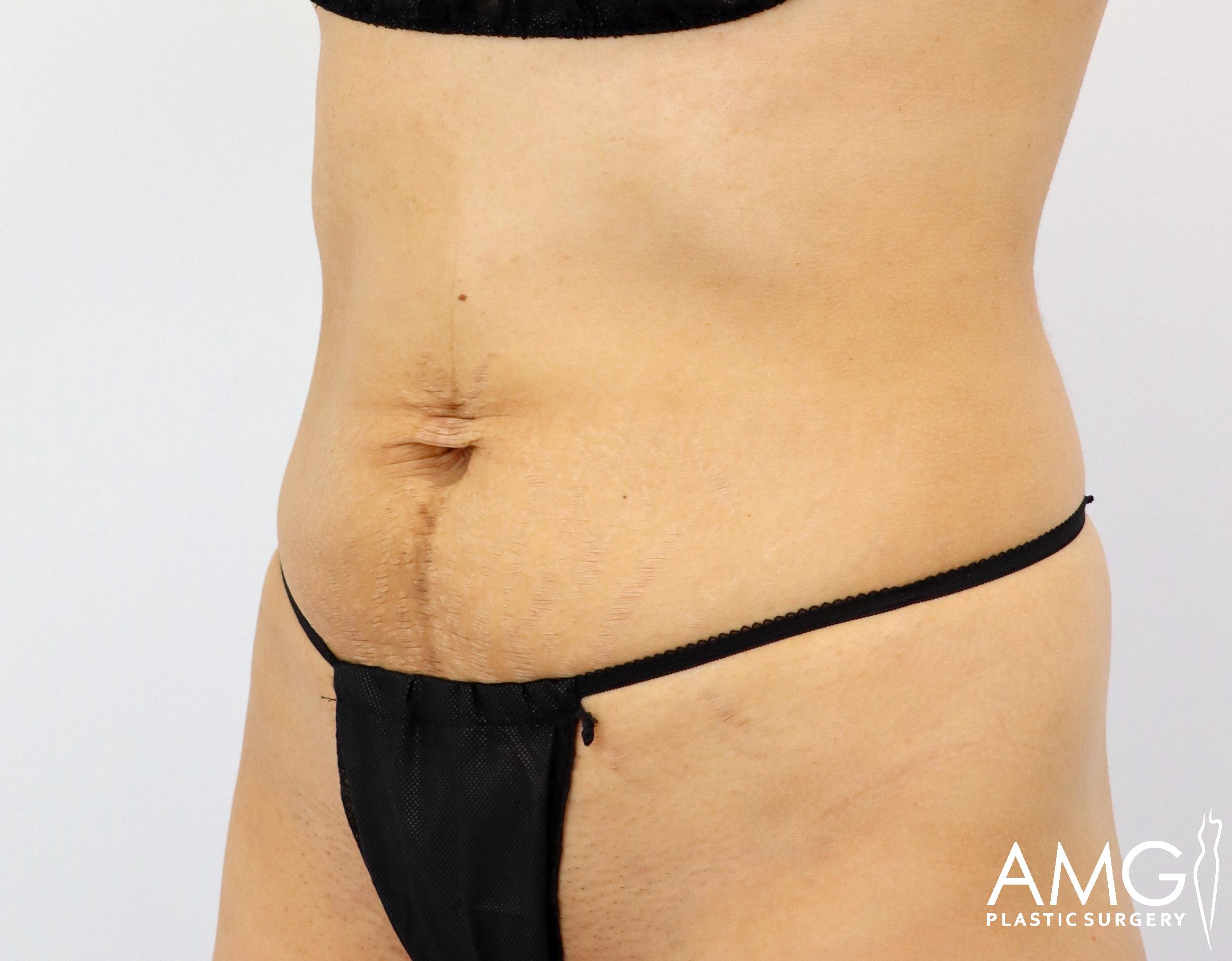 Person wearing black underwear, showing their abdomen with slightly loose skin and stretch marks. The image is watermarked with "AMG Plastic Surgery" in the bottom right corner.