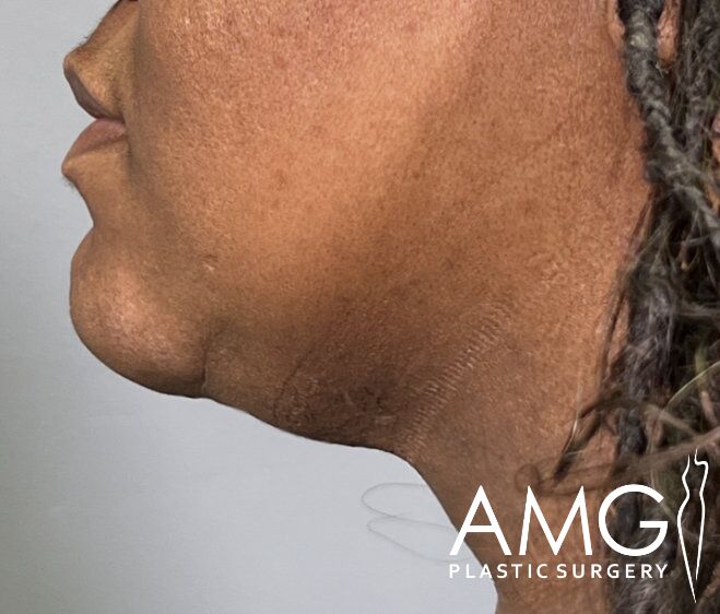 Side profile of a person's neck and jawline, showing skin texture and contours. Text reads "AMG Plastic Surgery" with a silhouette of a body.