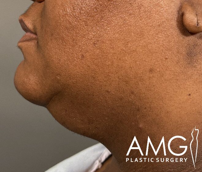 Close-up of a person's profile showing the lower face and neck area. The image is branded with the logo "AMG Plastic Surgery" at the bottom right corner.