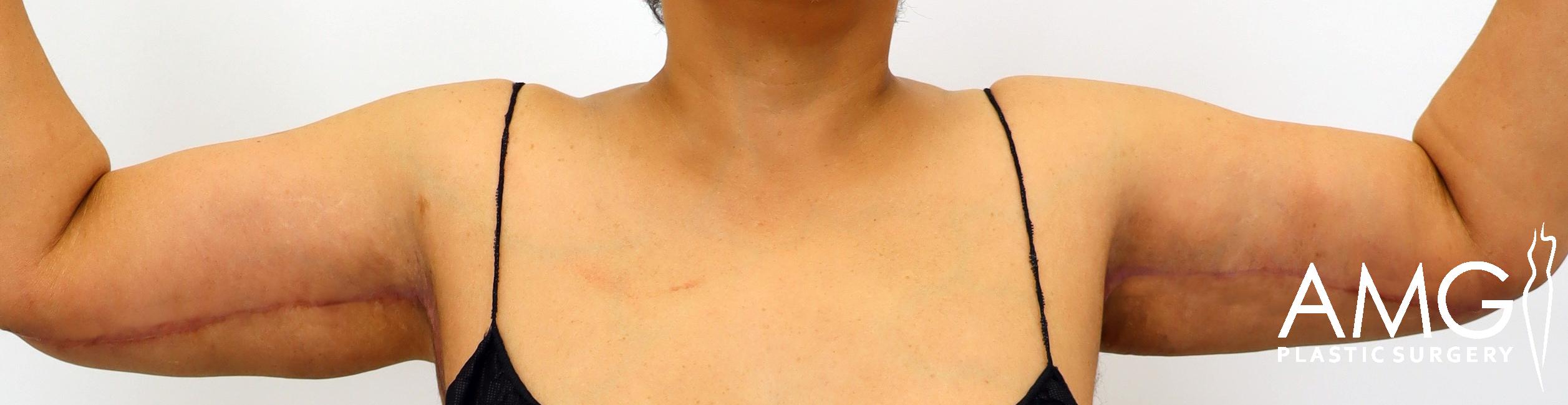 A person with bare shoulders and arms raised, displaying surgical scars on the inner arms. Wearing thin black straps and positioned against a plain background. "AMG Plastic Surgery" logo is visible.