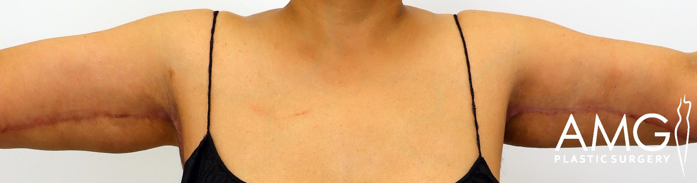 Person showing scars on upper arms in a tank top. The logo "AMG Plastic Surgery" is at the bottom right.