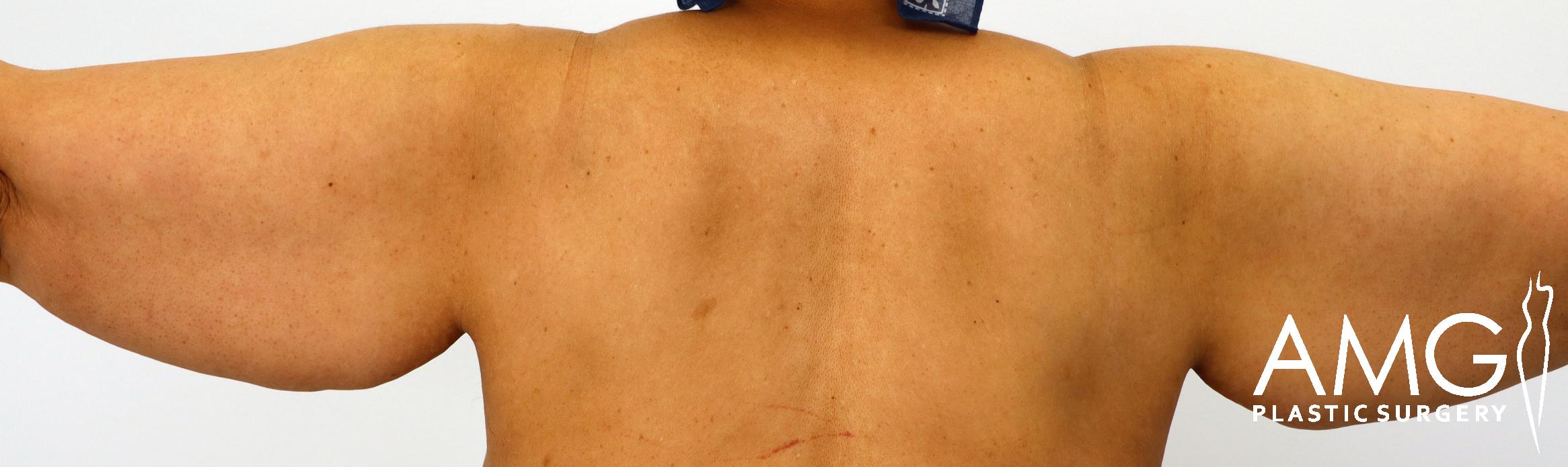 A person with excess skin on the upper arms, viewed from the back. The image includes a logo in the lower right corner.