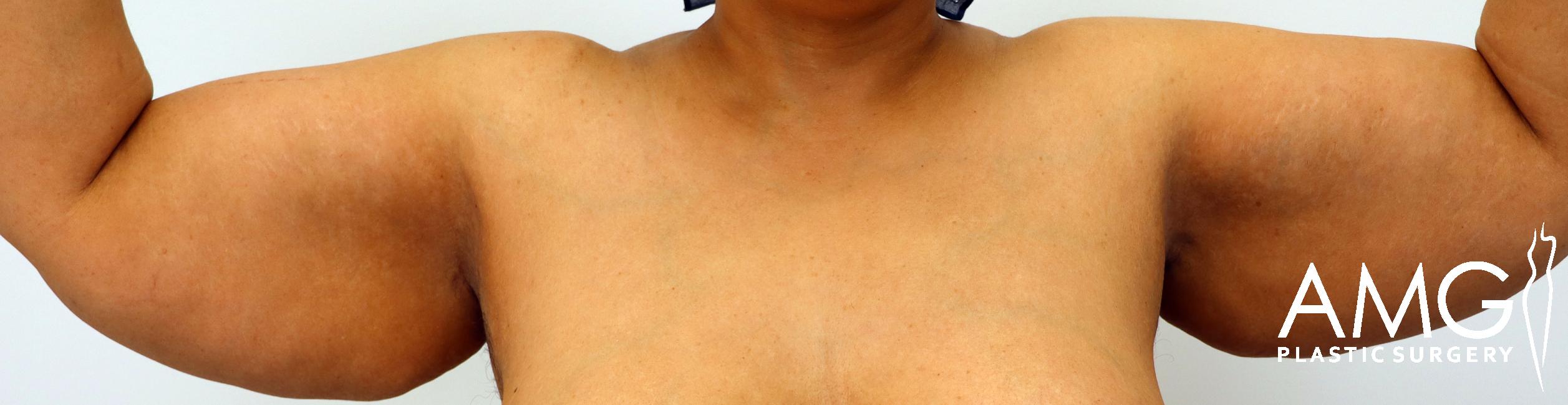 A person flexes their arms, showing loose skin and fat on the upper arms. Logo in the bottom right corner reads "AMG Plastic Surgery.