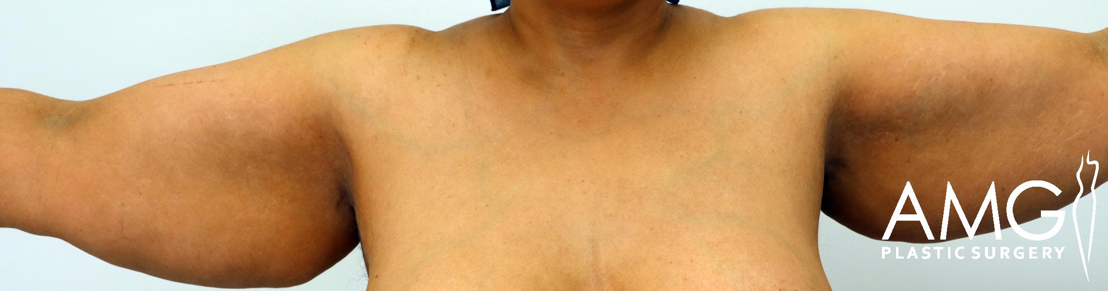 Person showing arms spread out, with visible skin and tissue. "AMG Plastic Surgery" logo is in the bottom right corner.