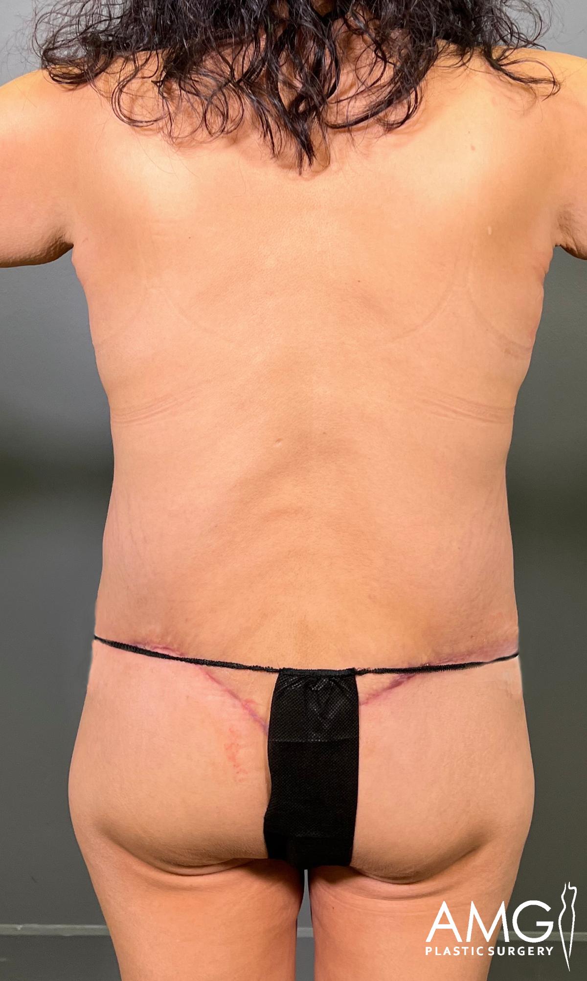 A person stands with their back to the camera, showing a healing surgical scar across the lower back and hips. They are wearing a black garment over the lower body. The logo AMG Plastic Surgery is visible in the lower right corner.