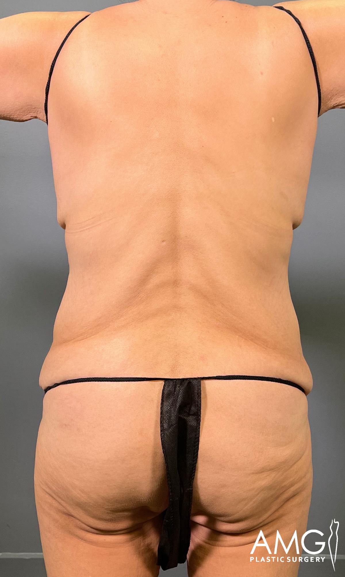 A person stands with arms raised, showing their back and waist. The person is wearing minimal black clothing, and there is a logo for AMG Plastic Surgery in the bottom right corner.