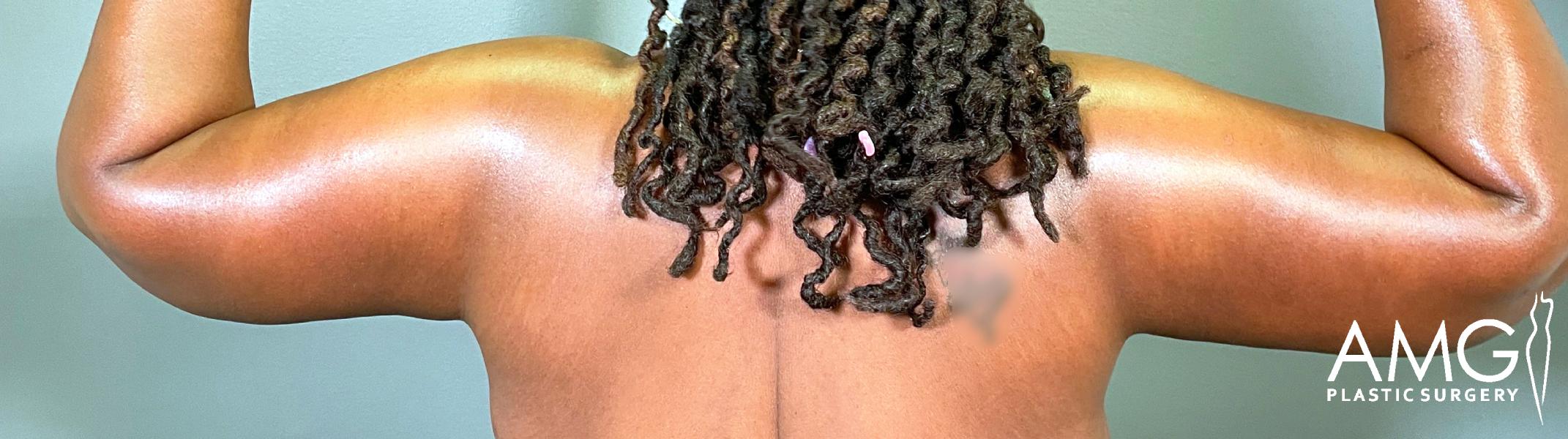 A person with medium to dark skin tone faces away, flexing their arms to show their back muscles. They have tightly curled, shoulder-length hair. The logo AMG Plastic Surgery is visible in the bottom right corner.