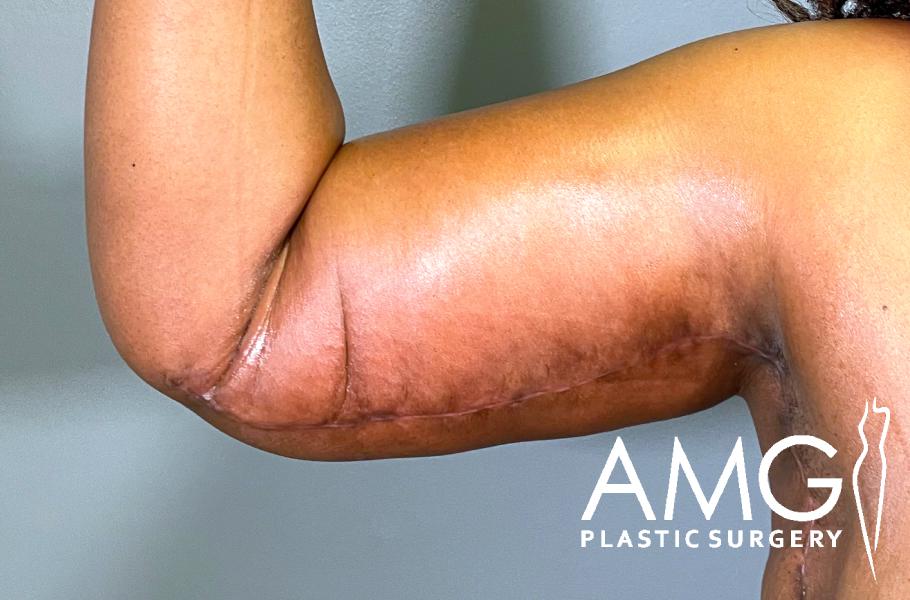 A close-up of a person’s flexed arm showing a long, healed surgical scar along the underside, with the AMG Plastic Surgery logo in the corner.